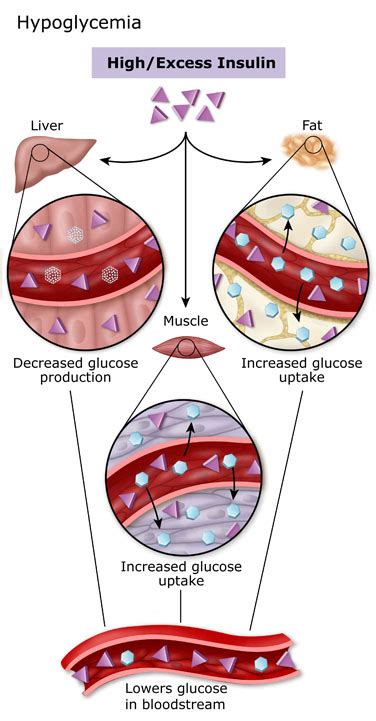 Hypoglycemia Diabetes Education Online