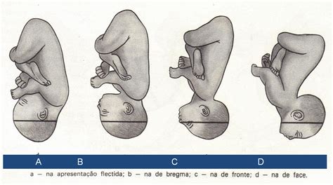 Apresentação Cefálica E Dorso à Esquerda LIBRAIN