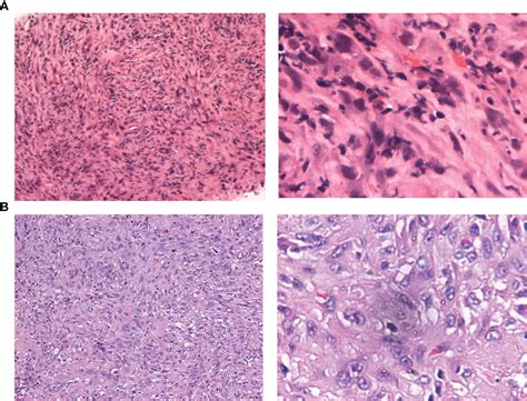 Frontiers Surgery After Combination Therapy With A Tyrosine Kinase