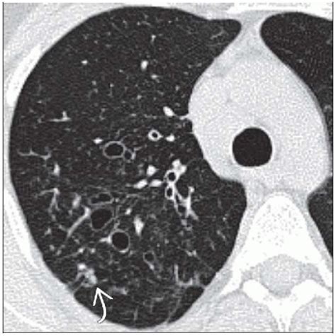 Allergic Bronchopulmonary Aspergillosis Radiology Key