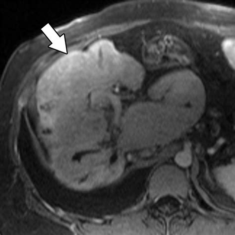 Imaging Features Of Primary Sclerosing Cholangitis From Diagnosis To Liver Transplant Follow Up