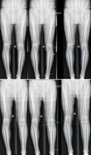 Artificial Intelligence Based Analyses Of Varus Leg Alignment And After