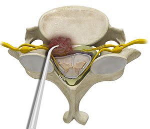 Spinal Tumor Surgery Milwaukee | Spinal Tumor Treatment Franklin ...