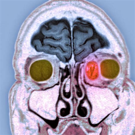 Secondary Cancer 2 By Simon Frasernewcastle Hospitals Nhs Trustscience Photo Library