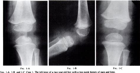Figure 1 From Primary Subacute Epiphyseal Osteomyelitis Semantic Scholar