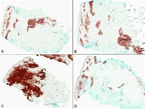 A Positive Immunohistochemical Ihc Staining With Cd Marker B