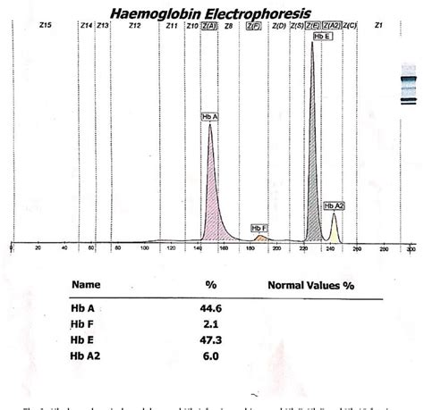 Figure 3 From Challenge In Diagnosis Of Hemoglobin Ebeta Thalassemia During Pregnancy A Case