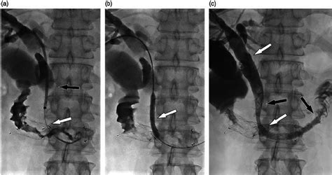 Percutaneous Transhepatic Cholangiograms Obtained In A Year Old Man