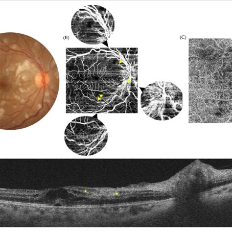 Purtscher Like Retinopathy Multimodal Assessment Of The Affected Eye Download Scientific