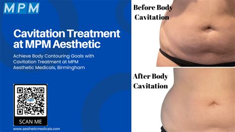 Cavitation Treatment At MPM Aesthetic Medicals Birmingham