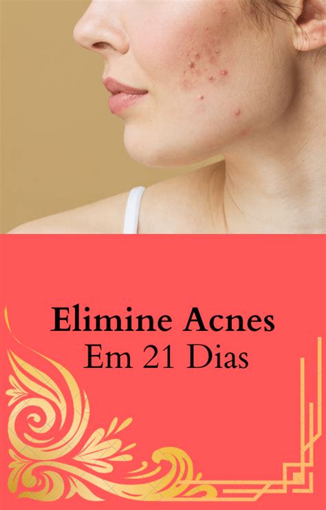 Elimine Acnes Josué de Quadros Hotmart