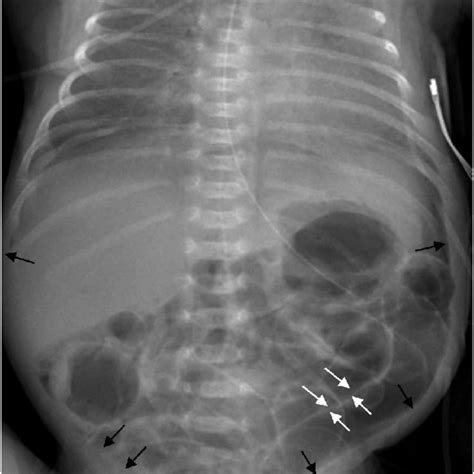 Supine Radiograph Of Twin B Demonstrating Presence Of Air On Both Sides Download Scientific