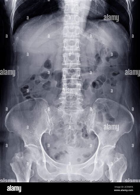 X Ray Abdomen Showing Anatomical In Abdomen For Diagnotic Abdominal