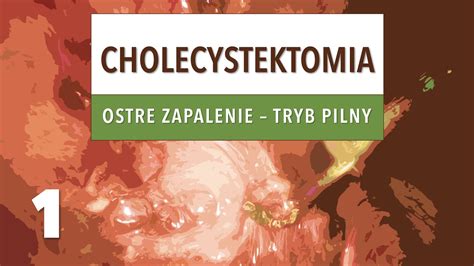 Cholecystektomia w ostrym zapaleniu pęcherzyka żółciowego 1 YouTube