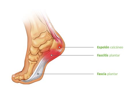 Fascitis plantar Podología Tossa de Mar