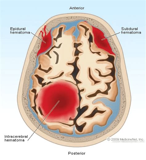 Hematomas O que é Causas Sintomas e Tratamento