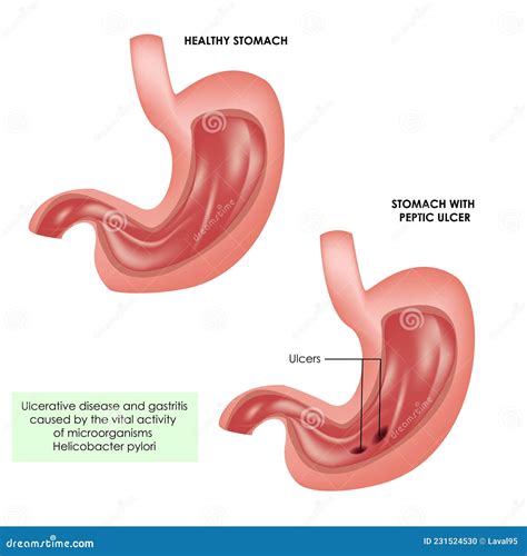 Lceras G Stricas Y Estomacales Sanas Ilustraci N M Dica Realista