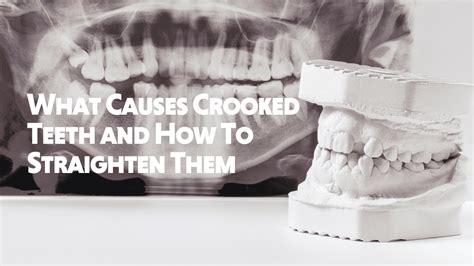 Find Out What Causes Crooked Teeth And How To Straighten Them