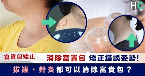 富貴包矯正丨消除富貴包 從中醫角度剖析4大方法 Health Concept