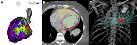 Stereotactic Body Radioablation For Refractory Ventricular Tachycardia