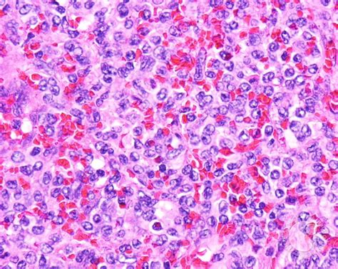 Hairy Cell Leukemia Variant 10