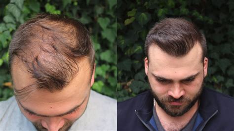 Hair Transplant Result With 3040 Grafts Extreme Transformation From 0