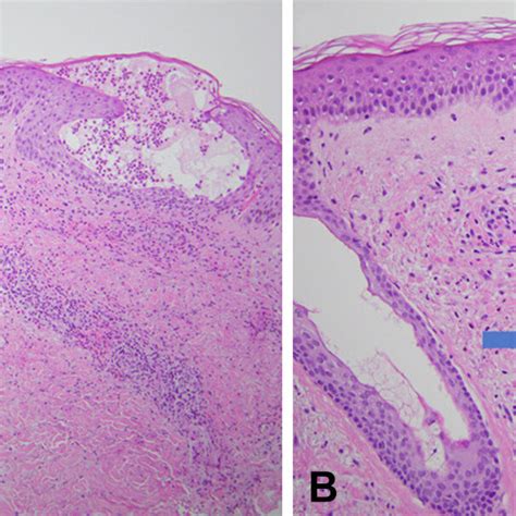 Leukocytoclastic Vasculitis Panels A And B Reveal Spongiosis And Mixed