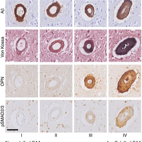 Adjacent Cortical Angiopathic Vessels Showing Different Degree Of