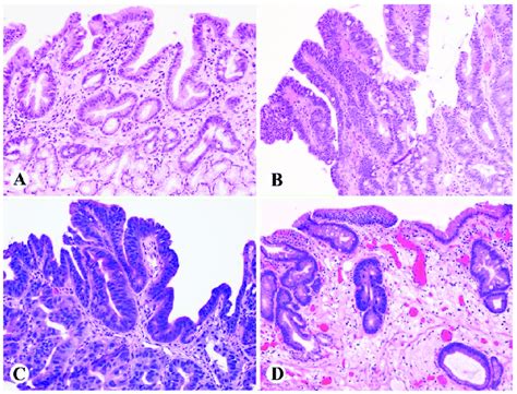 Examples Of Barretts Esophagus Surveillance Biopsy Without And With