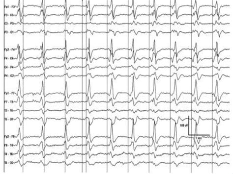 Periodic Eeg Patterns In The Intensive Care Unit Icu Definition