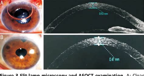 Figure 1 From Bedside Anterior Segment Optical Coherence Tomography