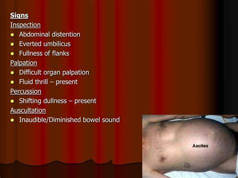 PPT - ASCITES Abnormal accumulation of fluid in the peritoneal cavity ...