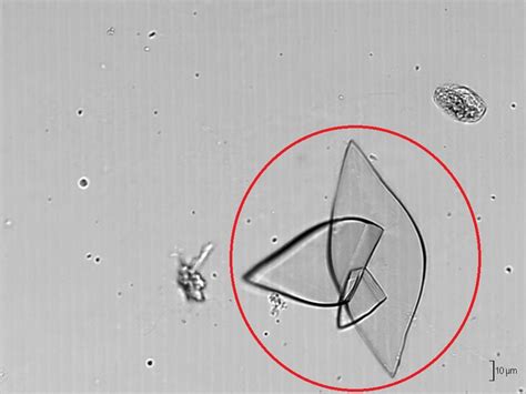 Types of Crystals Found In Human Urine and Their Clinical Significance ...