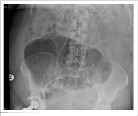 Figure 3 From Acute Presentation Of Intestinal Malrotation In Adults A Report Of Two Cases