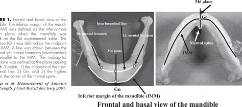 Incisive Canal Mandible