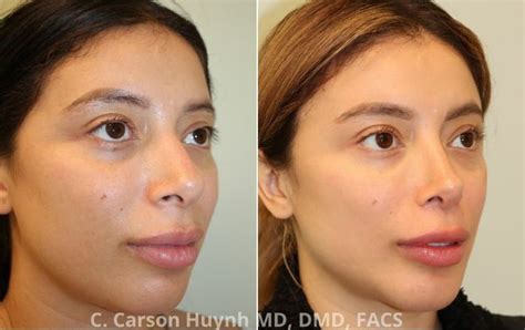 Hispanic Rhinoplasty Case 4701 Radiance Surgery Aesthetic Medicine