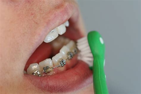 Surround Toothbrushes For Adults And Kids Mobile Medical