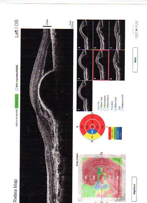 Dmla D G N Rescence Maculaire Li E Lage Cabinet D Ophtalmologie