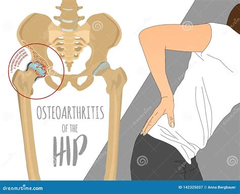 Arthroplasty Osteoarthritis Hip Joint Replacement Landing Page