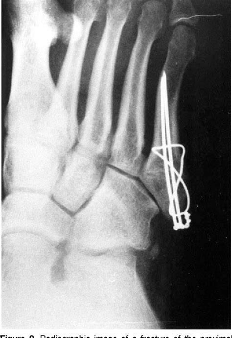 Figure From Tension Band Wiring For Fractures Of The Fifth Metatarsal