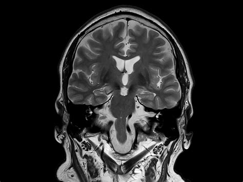 Brain With Multiple Lesions Philips Mr Body Map