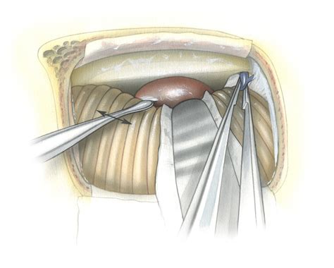 Retrosigmoid Approach Skull Base Surgery Atlas