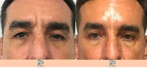 Blefaroplastia Antes y Después Dr Marco Romeo