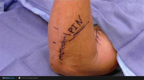 Distal Biceps Tendon Injuries Two Incision Distal Biceps Repair Using The Bicepsbutton™ Implant