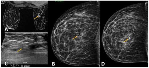 Diagnostics Free Full Text Challenges In Mri Guided Breast Biopsy And Some Suggested