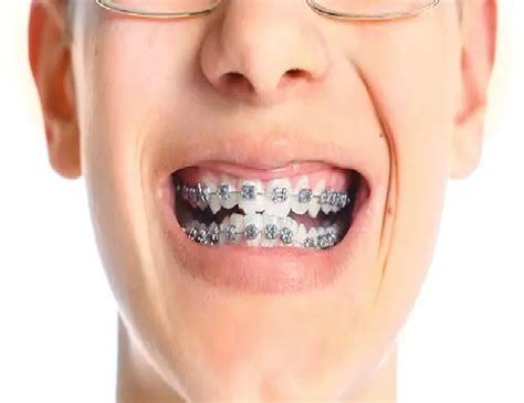 Tips And Tricks When Wearing Braces - Articledom