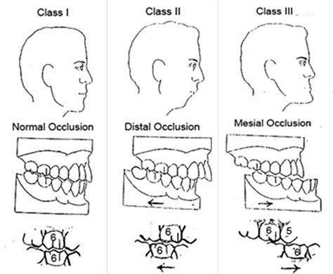 Types Of Malocclusion