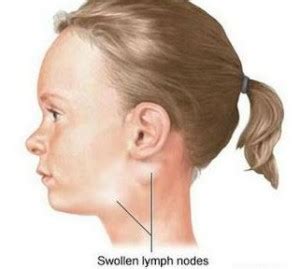 Swollen Glands in Neck - Symptoms, Causes, Treatment