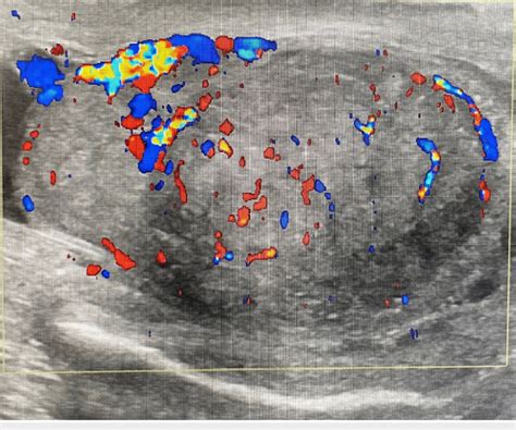 Scrotal Ultrasound Showing The Right Testis Is Enlarged Measuring 3 5