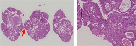 Infective Endocarditis Caused By Streptococcus Gallolyticus Subspecies